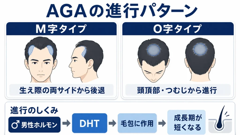AGAによる生え際の後退(M字タイプ)の特徴