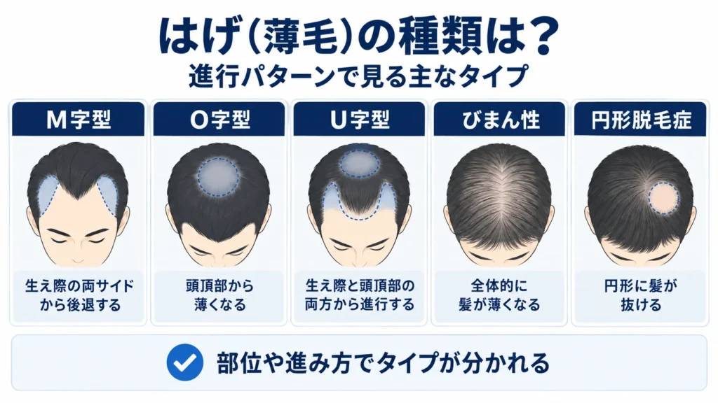 はげ(薄毛)の種類は?進行パターンで見る主なタイプ