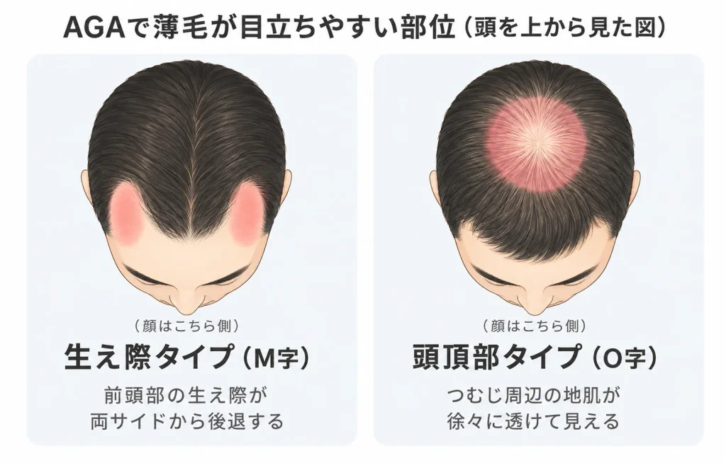 AGAかどうかのセルフチェック画像
